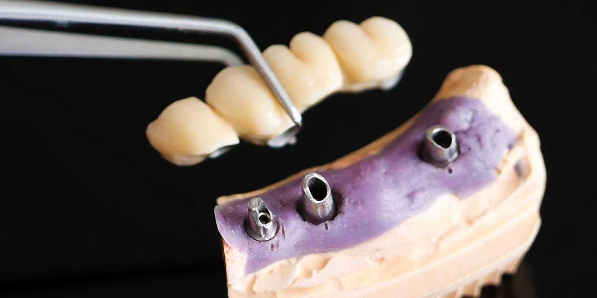 Dummy Implant Denture