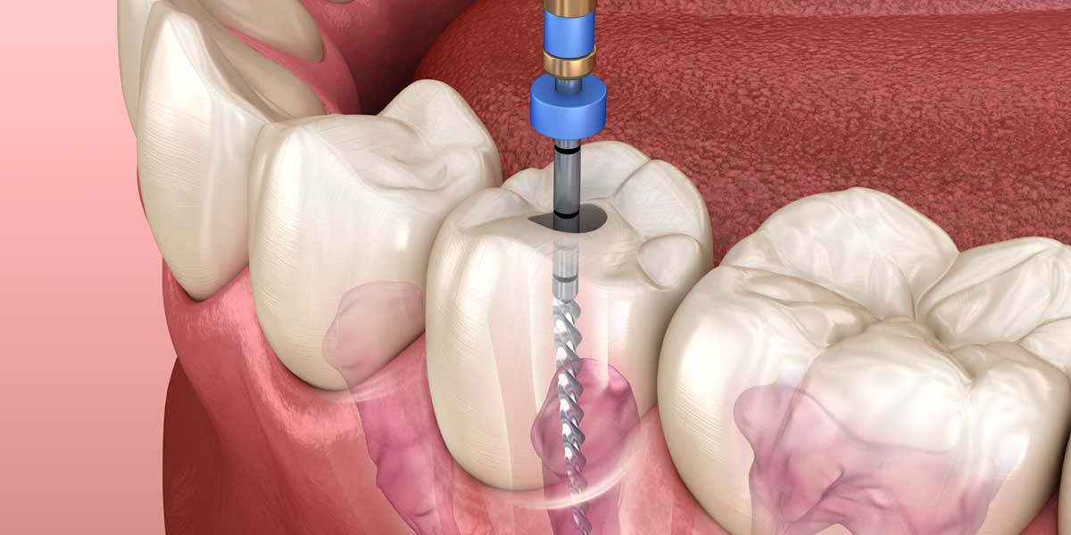 3D Root Canal