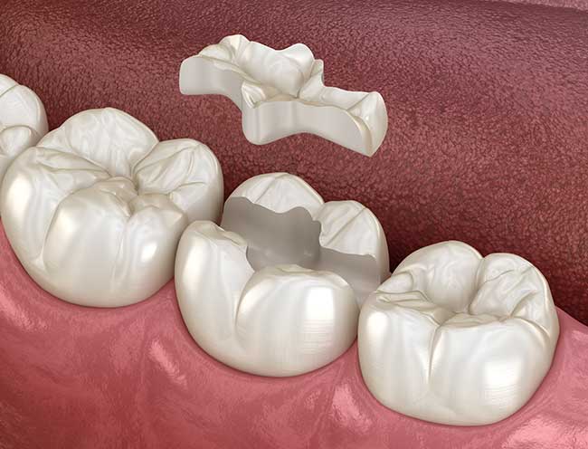 What Is Dental Plaque? - Northern Dental Design