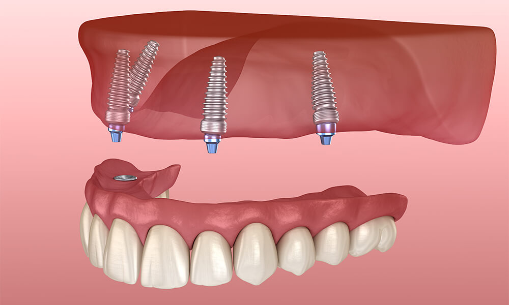 Full Mouth Dental Implants in Strongsville OH Area