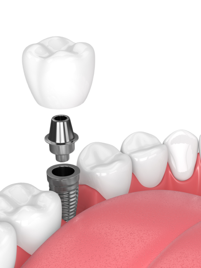 Discover the Magic of Dental Implants
