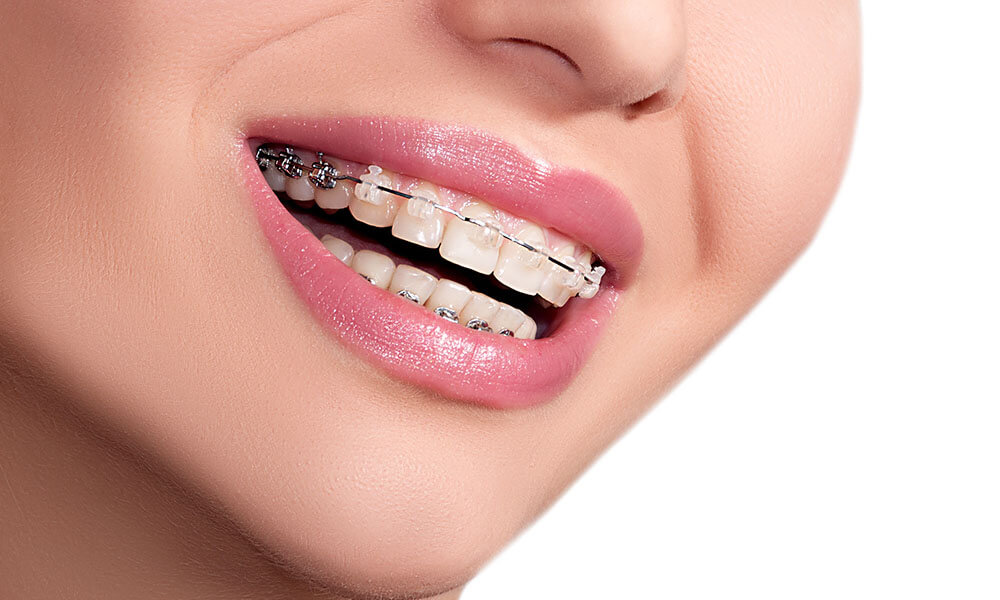 Fastbraces Orthodontics in Strongsville OH Area