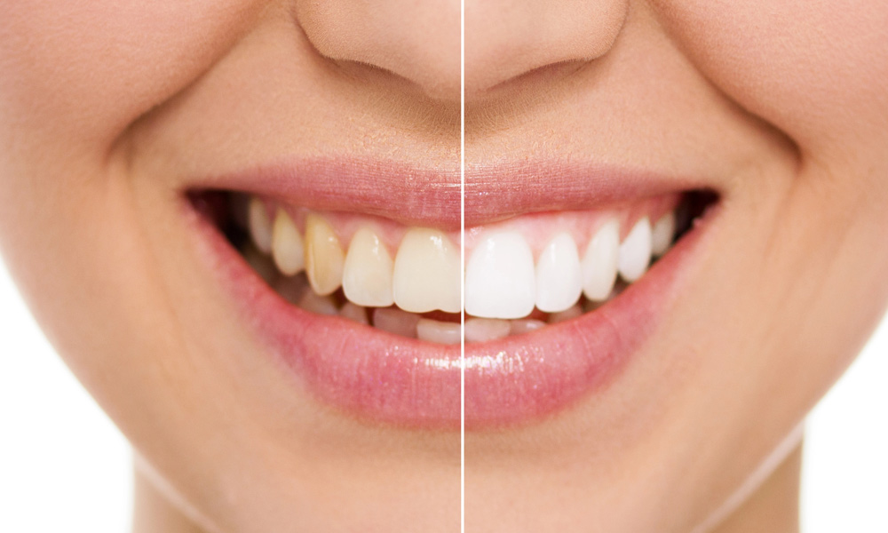 How Much Does Teeth Whitening Cost Strongsville OH