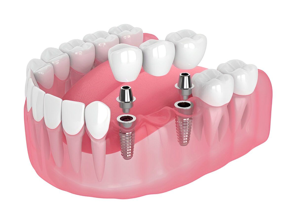Implant denture treatment available in Strongsville, Ohio for stable tooth replacement