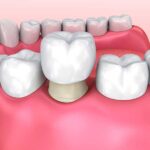 cerec crown