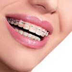 fastbr̥aces orthodontics