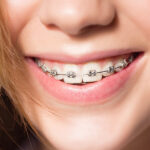 teeth straightening with fastbraces