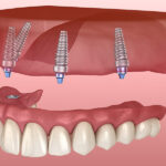 full mouth implants