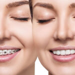 how long fast braces take