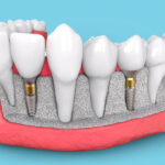 implant dentistry