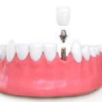 dental implants