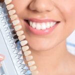 porcelain veneers