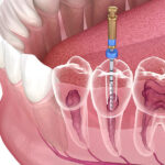 root canal treatment