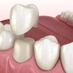 same day crown for front teeth