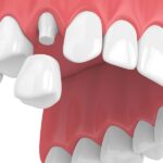 same day crowns