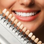 benefits of choosing same day veneers for smile makeovers