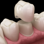 how same day crowns improve your smile and confidence