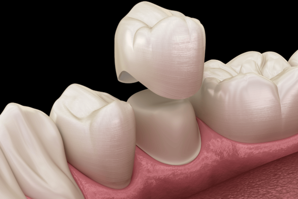 how same day crowns improve your smile and confidence
